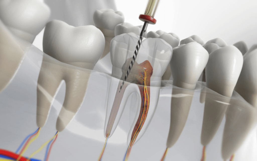 Root Canal Therapy