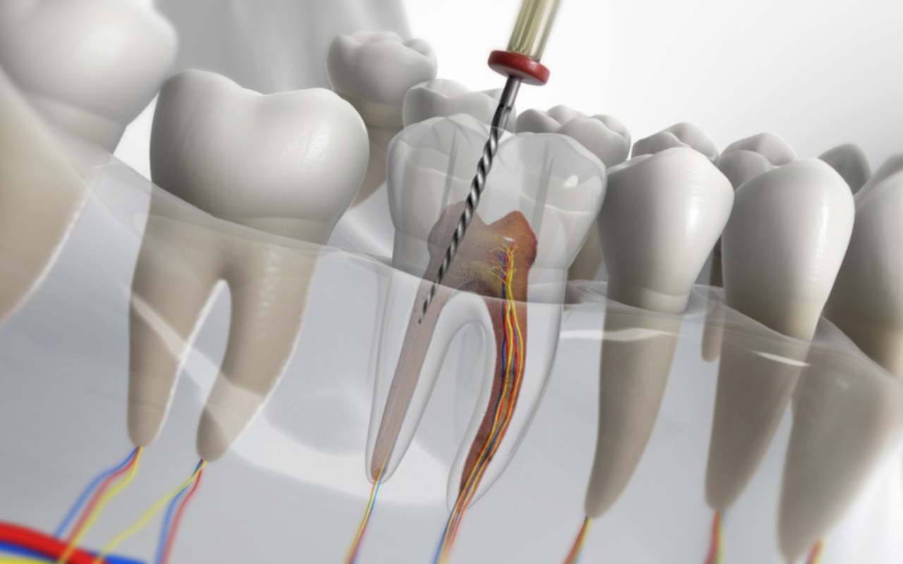 Root Canal Therapy