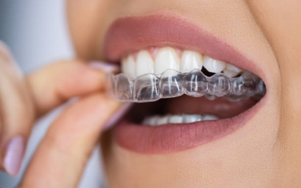 Clear Aligners