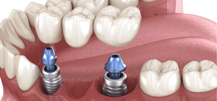 Implant-Supported Bridges