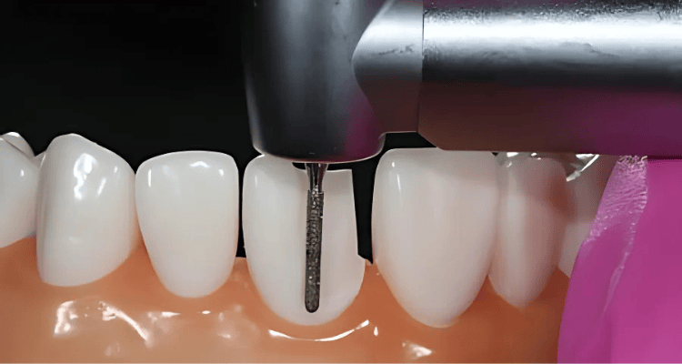 Teeth Treatment