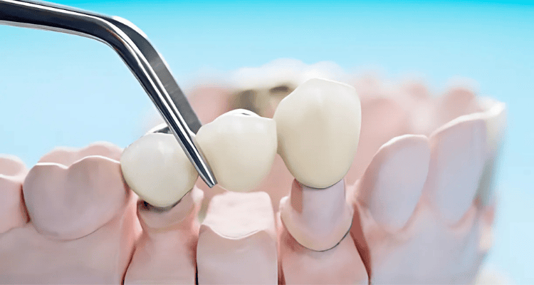 Traditional Dental Bridge