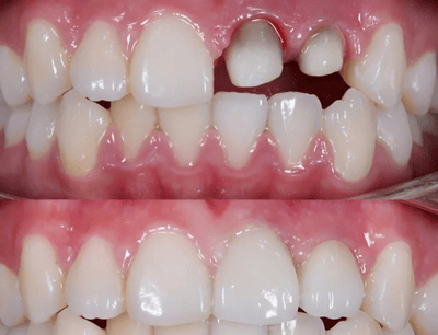 Crown Placement
