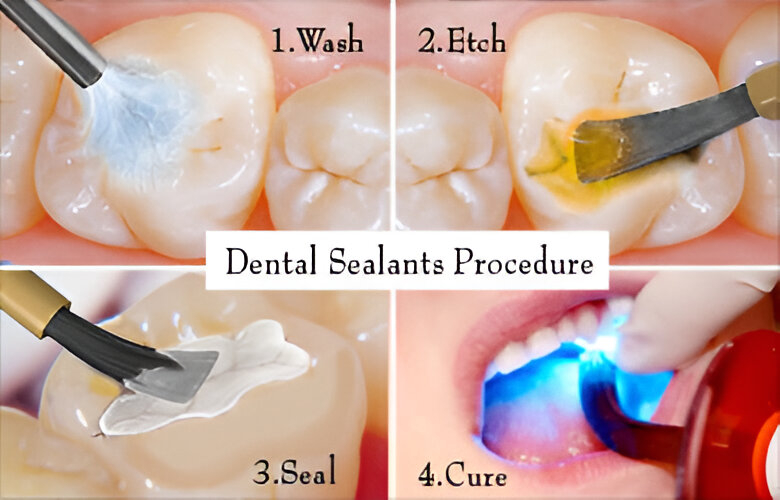 Dental-Sealants Procedure