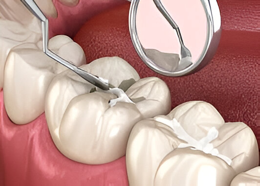 Dental Sealants Brampton