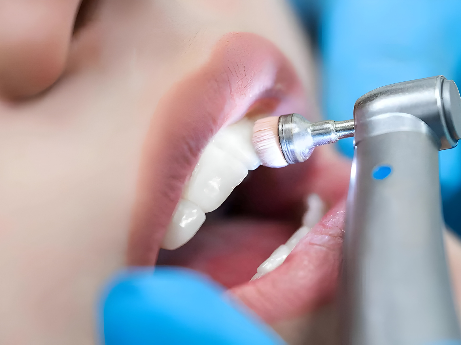 Full Dental Cleaning