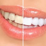How Teeth Whitening Works: Science Behind a Brighter Smile