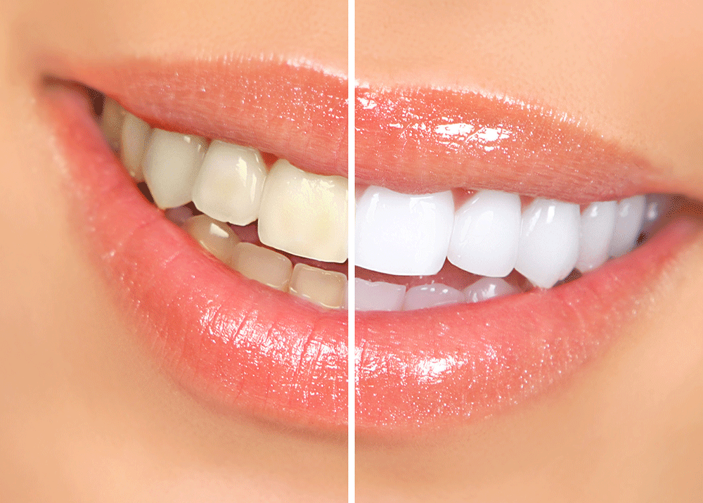 Teeth Whetening