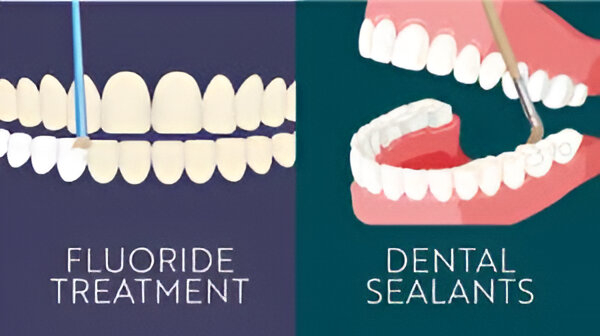 The Difference Between Sealants and Fluoride