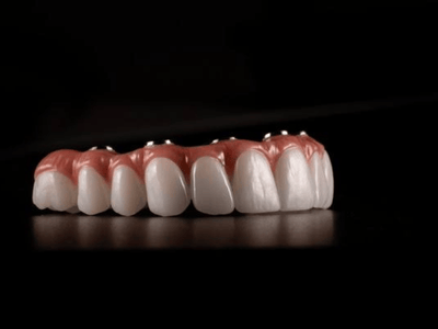 dental bridge