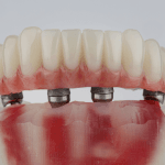 How Much Does a Dental Bridge Cost in Ontario?