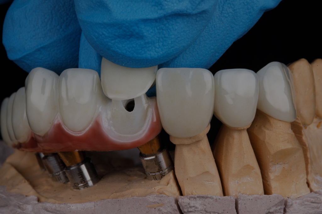 Dental Crown in Brampton