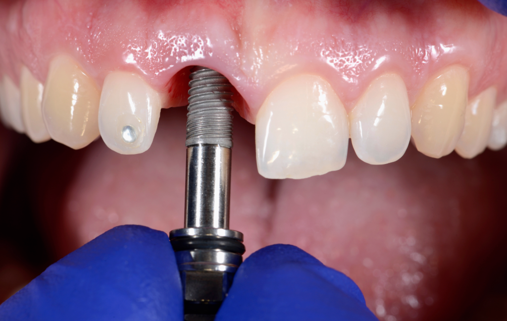 Dental Implants Brampton