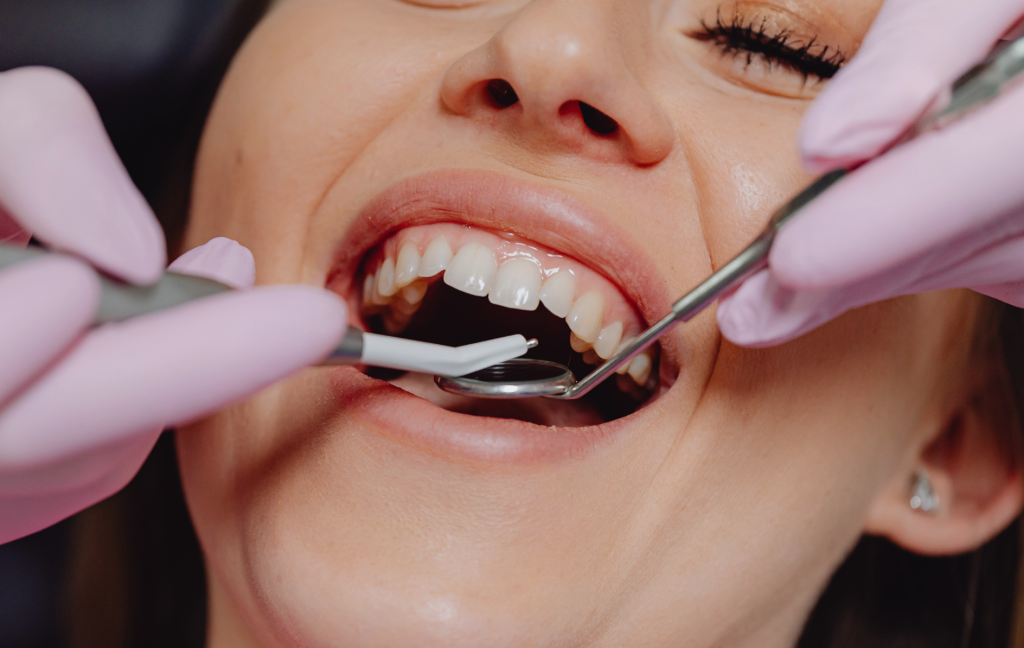 Dental Sealants Brampton