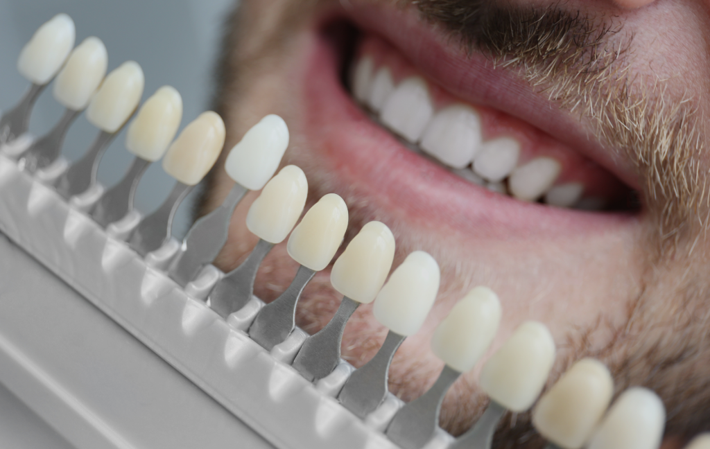 Dental Veneers Brampton