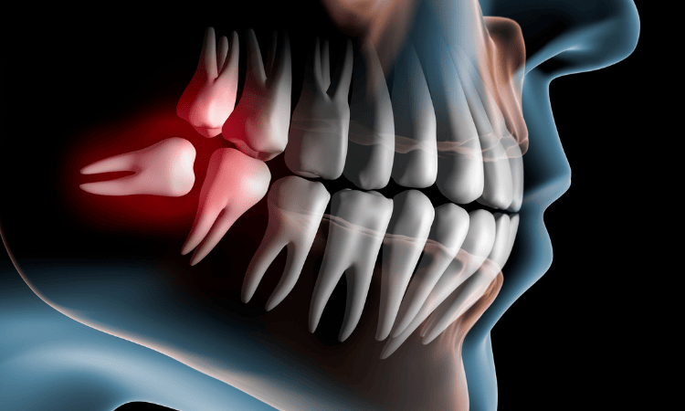 Wisdom Teeth Removal