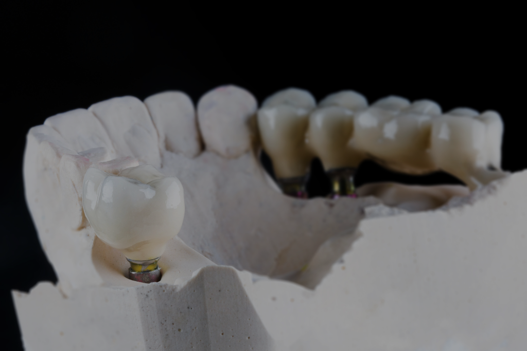 Dental Bridge 01