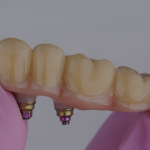 Dental Bridges Brampton: How Do They Improve Oral Health?
