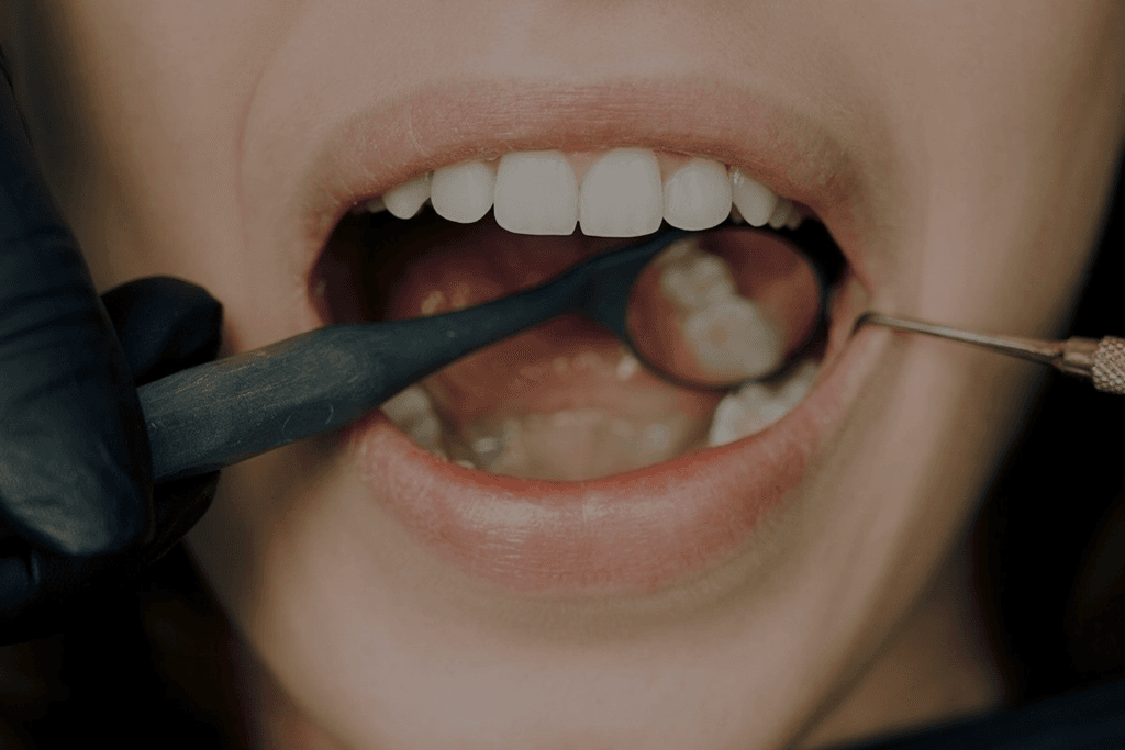Wisdom teeth removal 