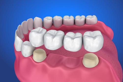 Traditional Dental Bridges
