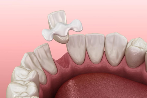 Maryland Dental Bridge