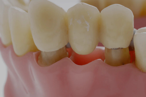 Cantilever Dental Bridge
