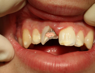 emergency dentistry woodhill 03