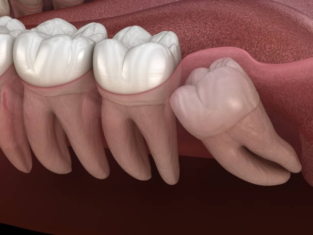 Wisdom tooth extraction