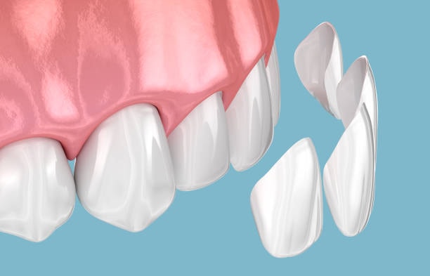 Dental Veneers Woodhill