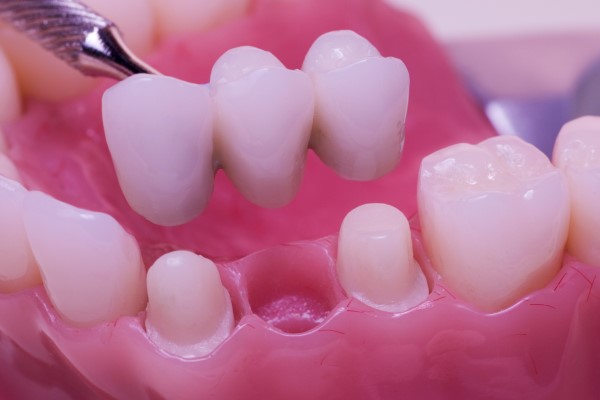 Dental Bridges Woodhill