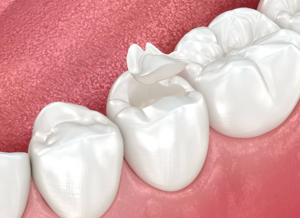 Dental Sealants Woodhill