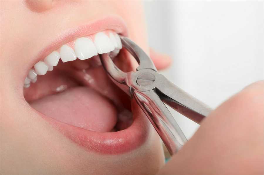 Tooth Extractions Woodhill