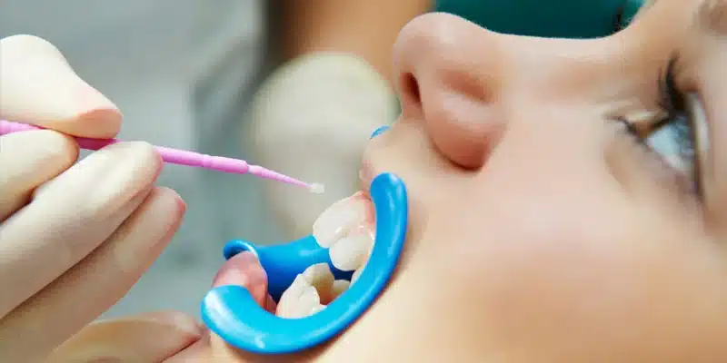 Dental Sealants Woodhill 01