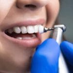 How Much Does Dental Cleaning Cost in Ontario?