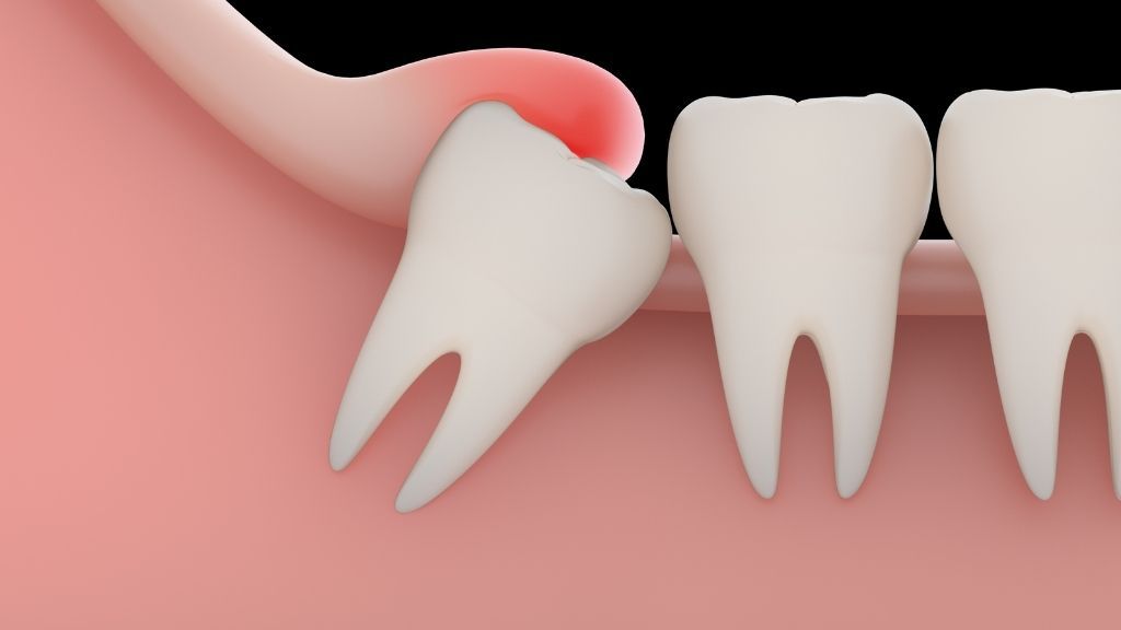 wisdom tooth extraction woodhill 02