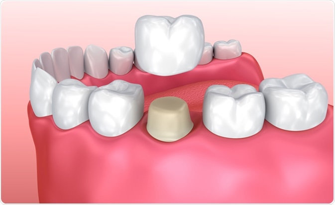 dental crown woodhill 02