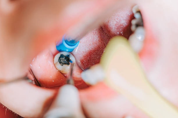 root canal treatment woodhill