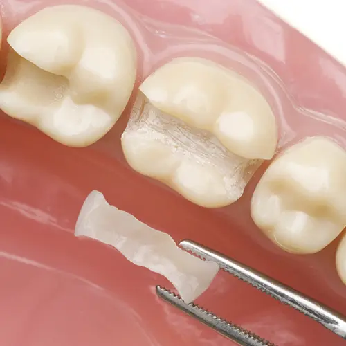 dental fillings woodhill
