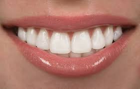 dental bonding woodhill