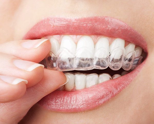 Invisalign Woodhill
