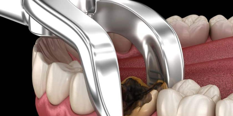 wisdom tooth extraction woodhill