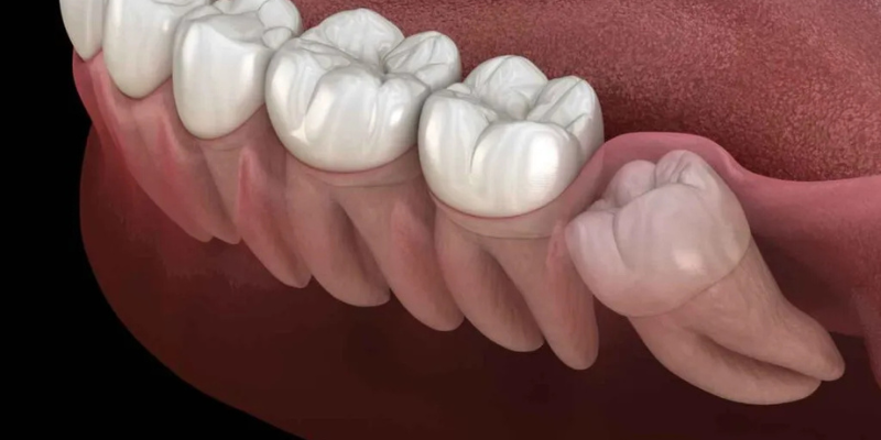 wisdom tooth extraction woodhill 01