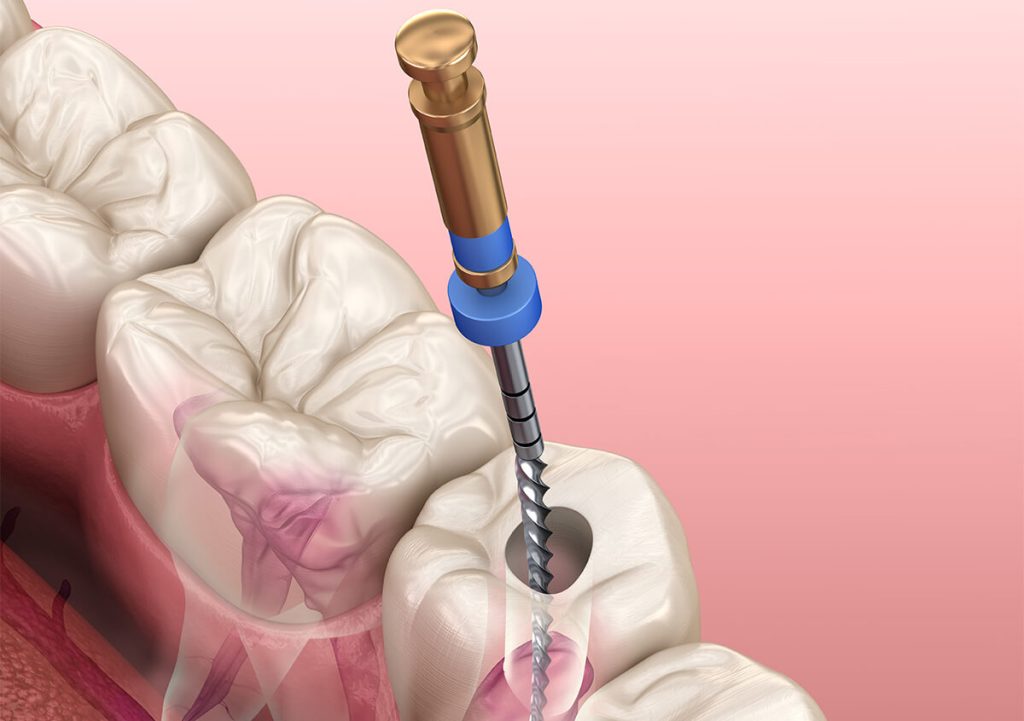 Root Canal Treatment Near Me