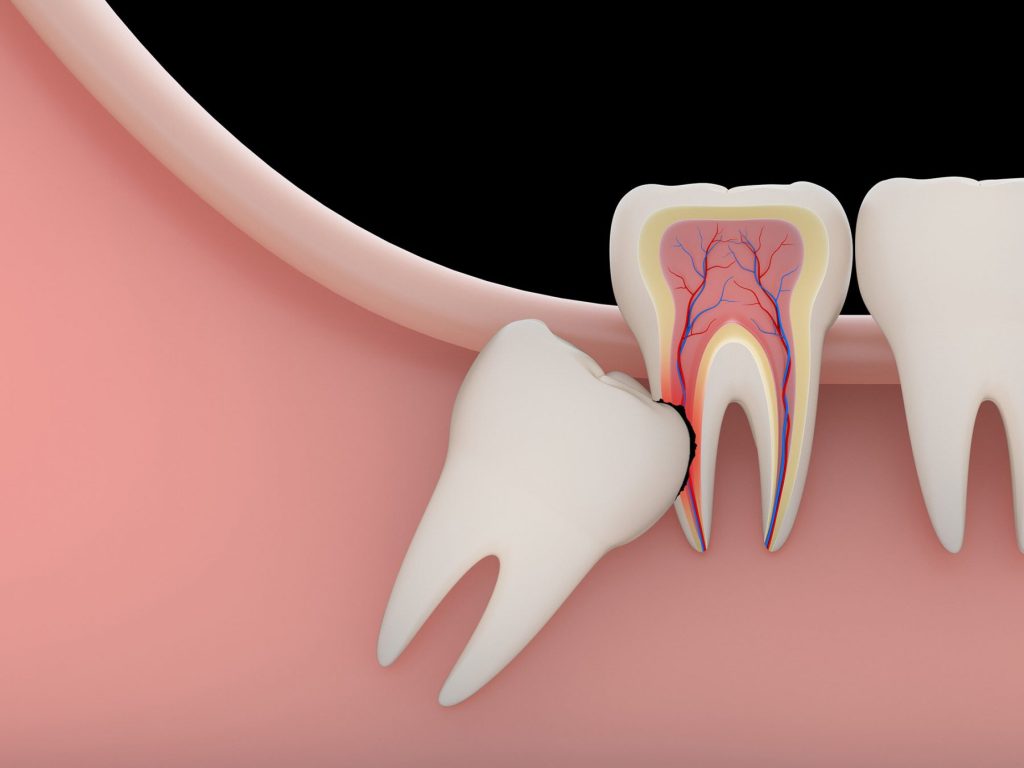 wisdom tooth removal near me