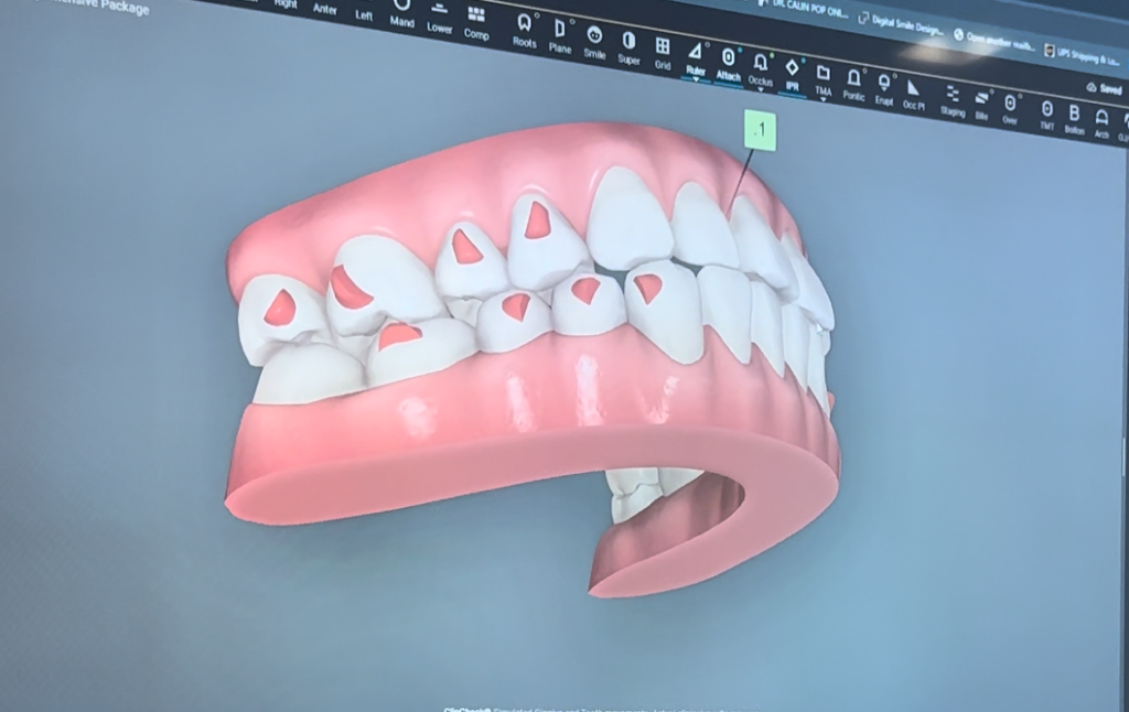 Invisalign