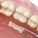 How Dental Sealants Prevent Cavities and Tooth Decay?