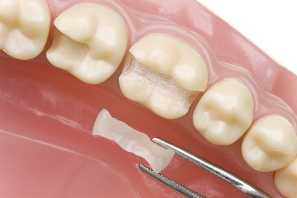 Dental Crown