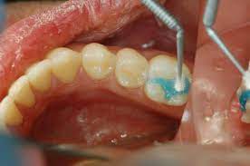 dental sealent