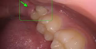 wisdom tooth removal