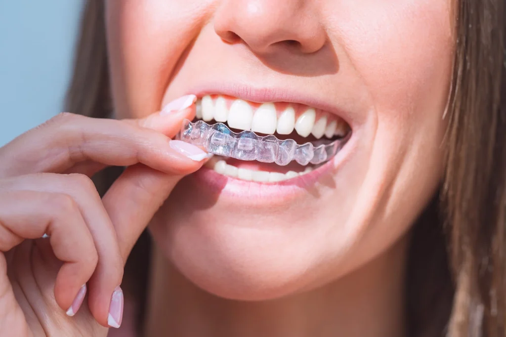 aligners
